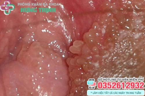 Hình ảnh mụn thịt ở vùng kín do gai sinh dục.