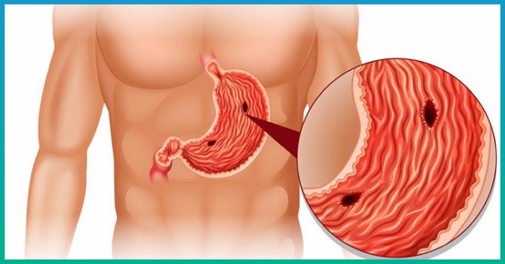 Tình trạng đau lâu ngày có thể bị thủng dạ dày