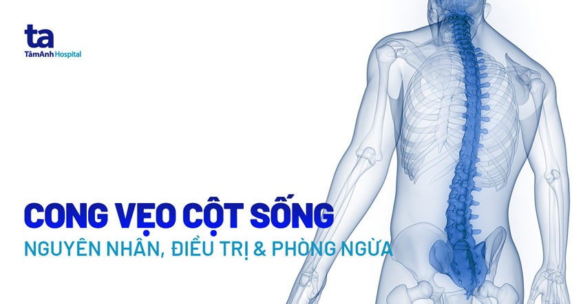 Cong Vẹo Cột Sống Sinh Học 8: Nguyên Nhân & Cách Phòng Ngừa Hiệu Quả Nhất? Cong Vẹo Cột Sống Sinh Học 8: Nguyên Nhân & Cách Phòng Ngừa Hiệu Quả Nhất?